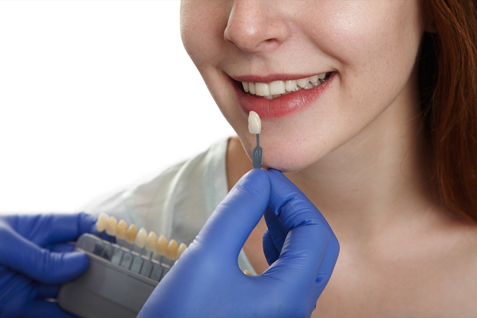 Escala de cor odontológica usada para registro antes do clareamento