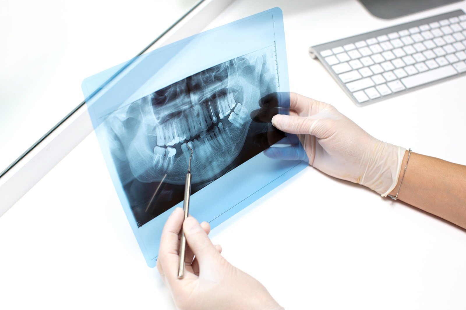 Radiografia periapical exibida em negatoscópio