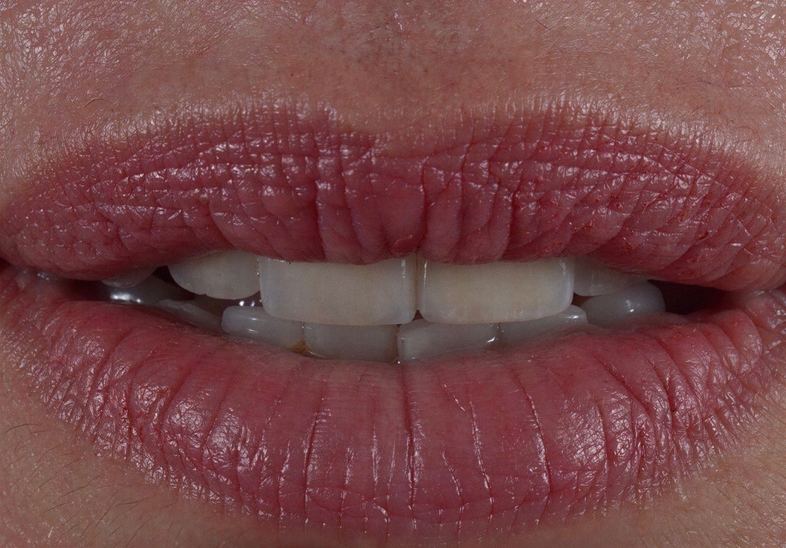 Clareamento dental
